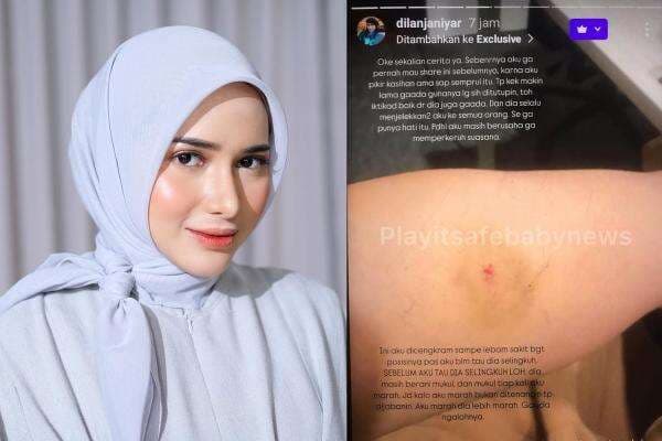 Dilan Janiyar Klaim Pernah Di-KDRT Safno, Lebam di Tangan dan Kaki Jadi Bukti