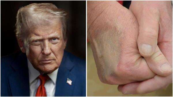 Tangan Donald Trump Bengkak dan Membiru, Kenali Gejala Awalnya