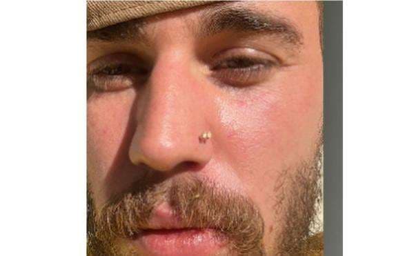 Penyakit Lyme Disease yang Diidap Justin Bieber, Ini Penyebab dan Cara Pengobatannya