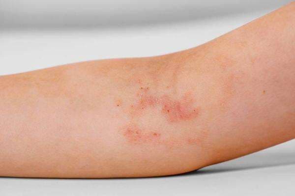 Viral Wanita Digigit Tomcat di Wajah, Andalkan Prosedur Estetika Bukan Salep Biasa