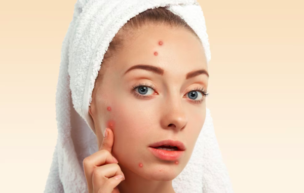 Benarkah Makan Kacang Sebabkan Jerawat? Yuk Simak 6 Fakta atau Mitos Terkait Masalah Kulit