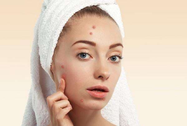 5 Tips Mudah Menghilangkan Jerawat di Dahi
