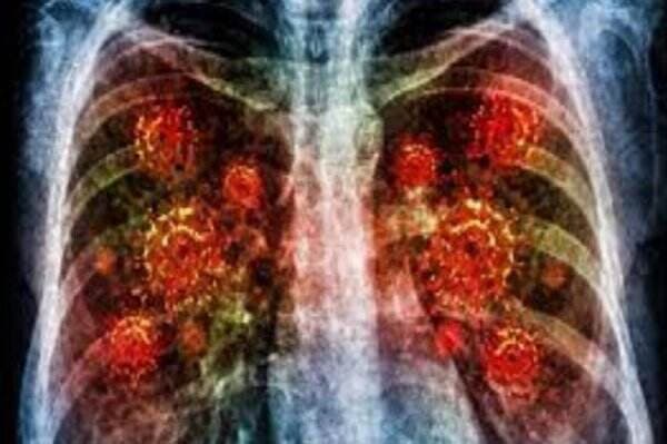 Risiko Mematikan, RSV Penyebab Pneumonia Utama pada Balita