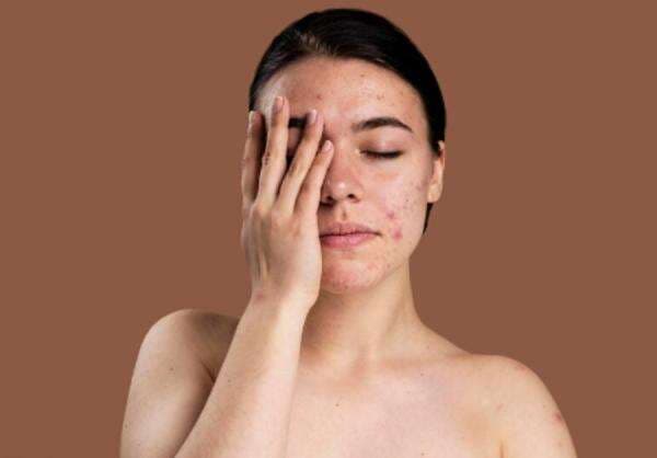 Pakai Sunscreen Malam Hari Bikin Jerawatan, Ini Penjelasannya