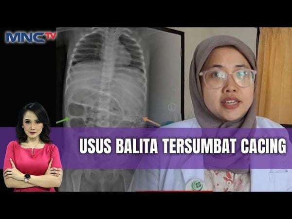 Anak 3 Tahun di Jember Alami Penyumbatan Usus Akibat Ratusan Cacing