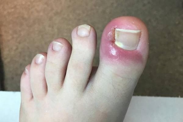 Intip Biaya Operasi Cantengan dengan dan tanpa BPJS Kesehatan Intip Biaya Operasi Cantengan dengan dan tanpa BPJS Kesehatan