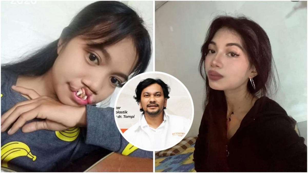 Viral Transformasi TikToker Rista, Pasien Bibir Sumbing yang Dioperasi Gratis Dokter Tompi! Viral Transformasi TikToker Rista, Pasien Bibir Sumbing yang Dioperasi Gratis Dokter Tompi!