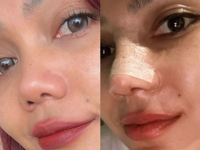 Rina Nose Oplas Hidung dengan Dokter Tompi? Ini Fotonya Rina Nose Oplas Hidung dengan Dokter Tompi? Ini Fotonya