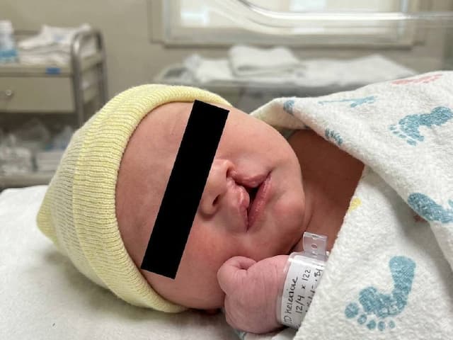 Apakah Bibir Sumbing Penyakit Keturunan? Ini Kata Dokter Apakah Bibir Sumbing Penyakit Keturunan? Ini Kata Dokter