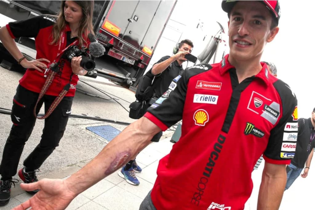 Luka Parah Marc Marquez Terungkap Jelang MotoGP Spanyol, Tetap Ngotot Balapan Luka Parah Marc Marquez Terungkap Jelang MotoGP Spanyol, Tetap Ngotot Balapan