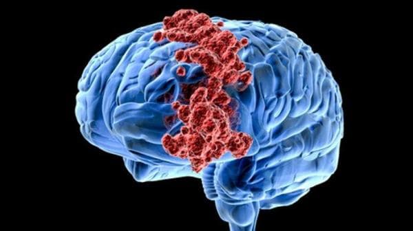 Kenali Gejala dan Risiko Tumor Otak