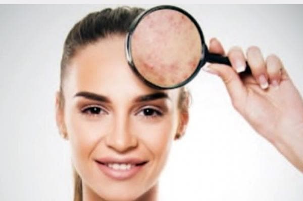 Jangan Sembrono untuk Hilangkan Flek Hitam di Wajah, ini Cara yang Lebih Aman dan Nyaman Jangan Sembrono untuk Hilangkan Flek Hitam di Wajah, ini Cara yang Lebih Aman dan Nyaman