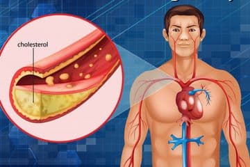 8 Cara Menurunkan Kolesterol Secara Alami Tanpa Obat