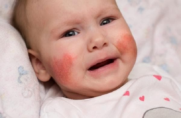 4 Cara Menghilangkan Bintik Merah di Wajah Bayi 4 Cara Menghilangkan Bintik Merah di Wajah Bayi