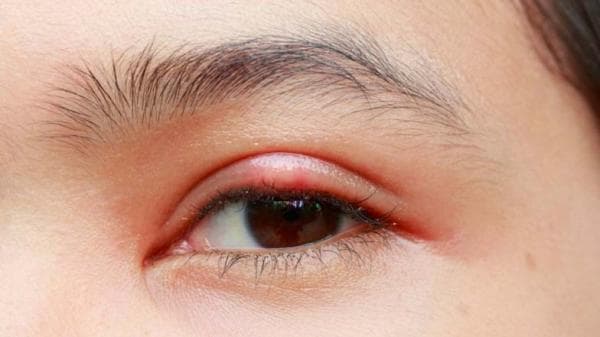 Waspadai Mata Bintitan, ini Penyebab dan Cara Mengatasi Waspadai Mata Bintitan, ini Penyebab dan Cara Mengatasi