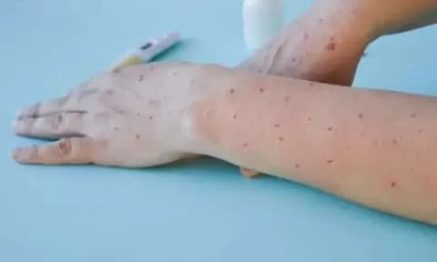 Menghilangkan Bekas Cacar yang Berlubang Ternyata tidak Sulit Menghilangkan Bekas Cacar yang Berlubang Ternyata tidak Sulit