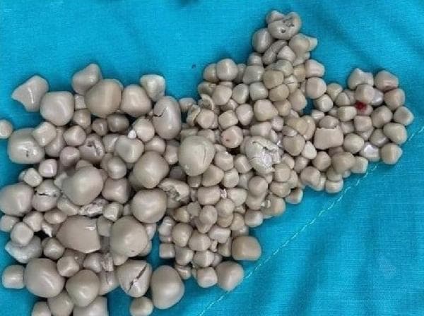 Akibat Sering Minum Boba, di Perut Wanita Ini Ada 300 Batu Ginjal Akibat Sering Minum Boba, di Perut Wanita Ini Ada 300 Batu Ginjal