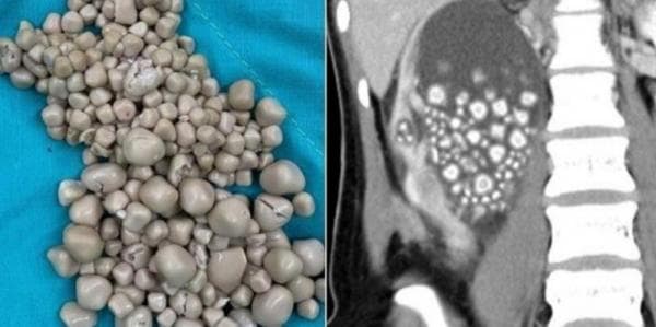 Ngeri, Gegara Suka Minuman Boba, Perempuan Kena Batu Ginjal Ngeri, Gegara Suka Minuman Boba, Perempuan Kena Batu Ginjal