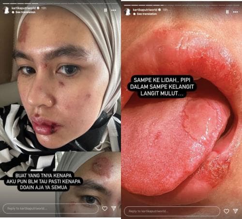 Wajah hingga Lidah Kartika Putri Melepuh, Netizen: Azab Suka Julid Wajah hingga Lidah Kartika Putri Melepuh, Netizen: Azab Suka Julid