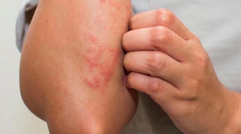 Ini 5 Cara Menghilangkan Gatal pada Kulit yang Tak Kunjung Sembuh, Bisa Pakai Bahan-Bahan Alami Ini 5 Cara Menghilangkan Gatal pada Kulit yang Tak Kunjung Sembuh, Bisa Pakai Bahan-Bahan Alami