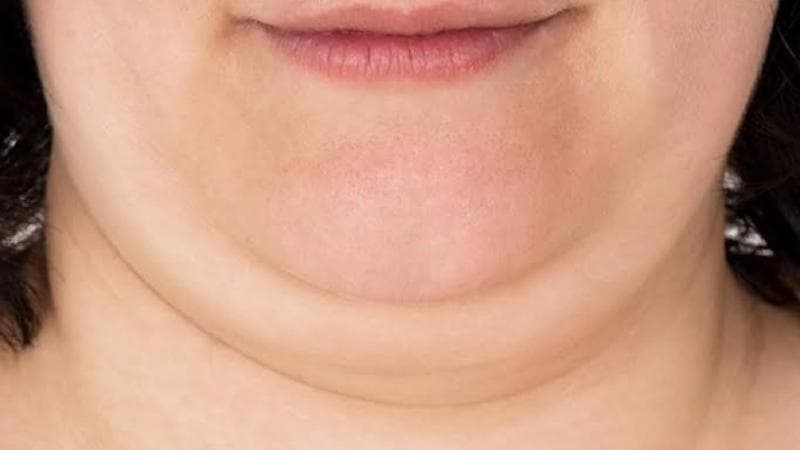 Tak Perlu Keluar Biaya, Begini 3 Cara Menghilangkan Double Chin dengan Mudah Tak Perlu Keluar Biaya, Begini 3 Cara Menghilangkan Double Chin dengan Mudah