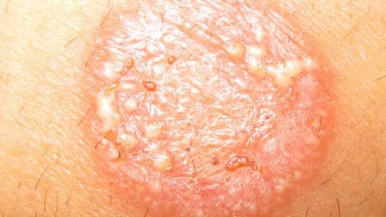 5 Cara Mudah Menghilangkan Kurap dengan Cepat Dalam 1 Hari, Simak Tips Berikut Ini! 5 Cara Mudah Menghilangkan Kurap dengan Cepat Dalam 1 Hari, Simak Tips Berikut Ini!