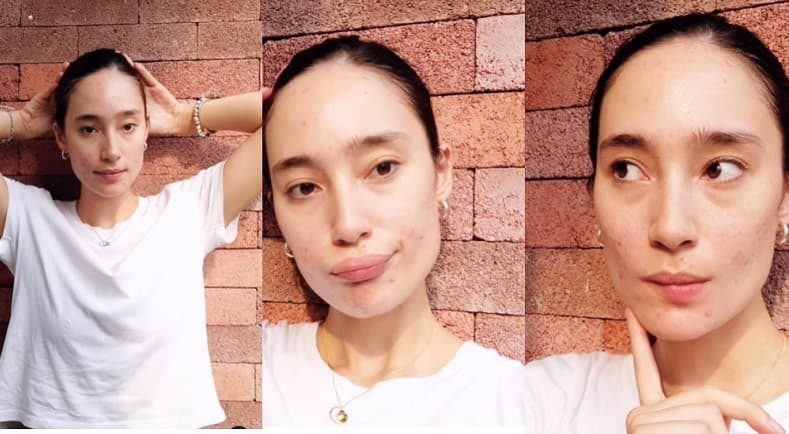 Potret Artis Tak Malu Pamer Wajah Jerawatan, Malah Dipuji Netizen Potret Artis Tak Malu Pamer Wajah Jerawatan, Malah Dipuji Netizen