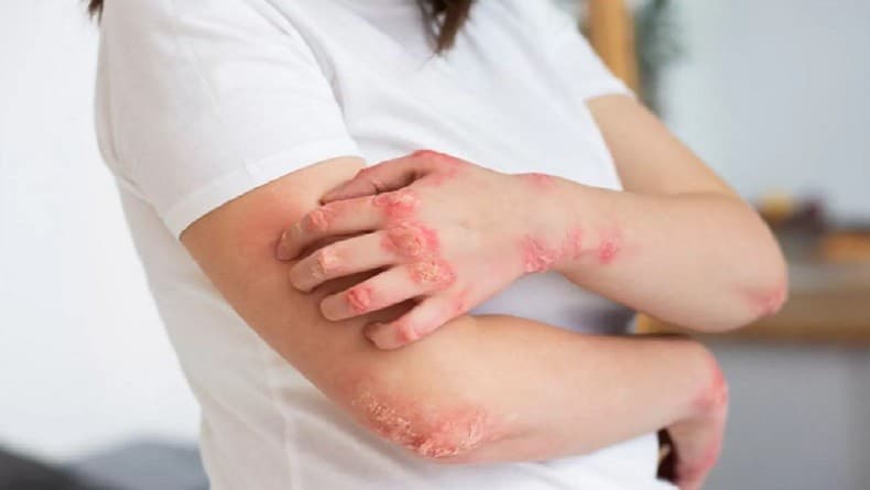 Cara Menghilangkan Kurap Sampai ke Akar secara Alami, Gampang Banget Cara Menghilangkan Kurap Sampai ke Akar secara Alami, Gampang Banget