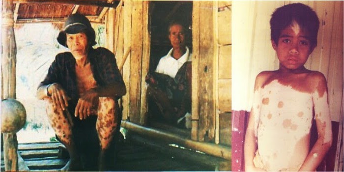 Mengenal Suku Tobalo, Manusia Belang di Kaki Gunung Pedalaman Sulawesi Mengenal Suku Tobalo, Manusia Belang di Kaki Gunung Pedalaman Sulawesi