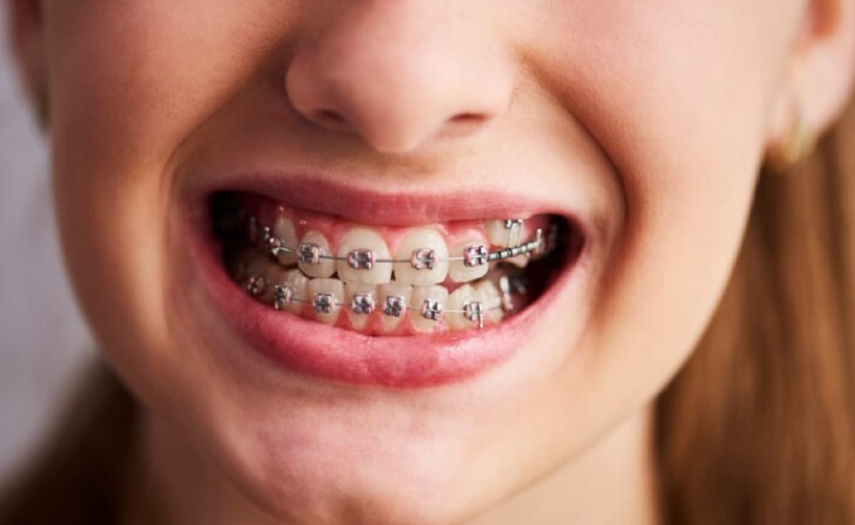 Gegara Pasang Behel Abal-Abal, TKW Taiwan Asal Madiun Ini Alami Infeksi Otak Gegara Pasang Behel Abal-Abal, TKW Taiwan Asal Madiun Ini Alami Infeksi Otak