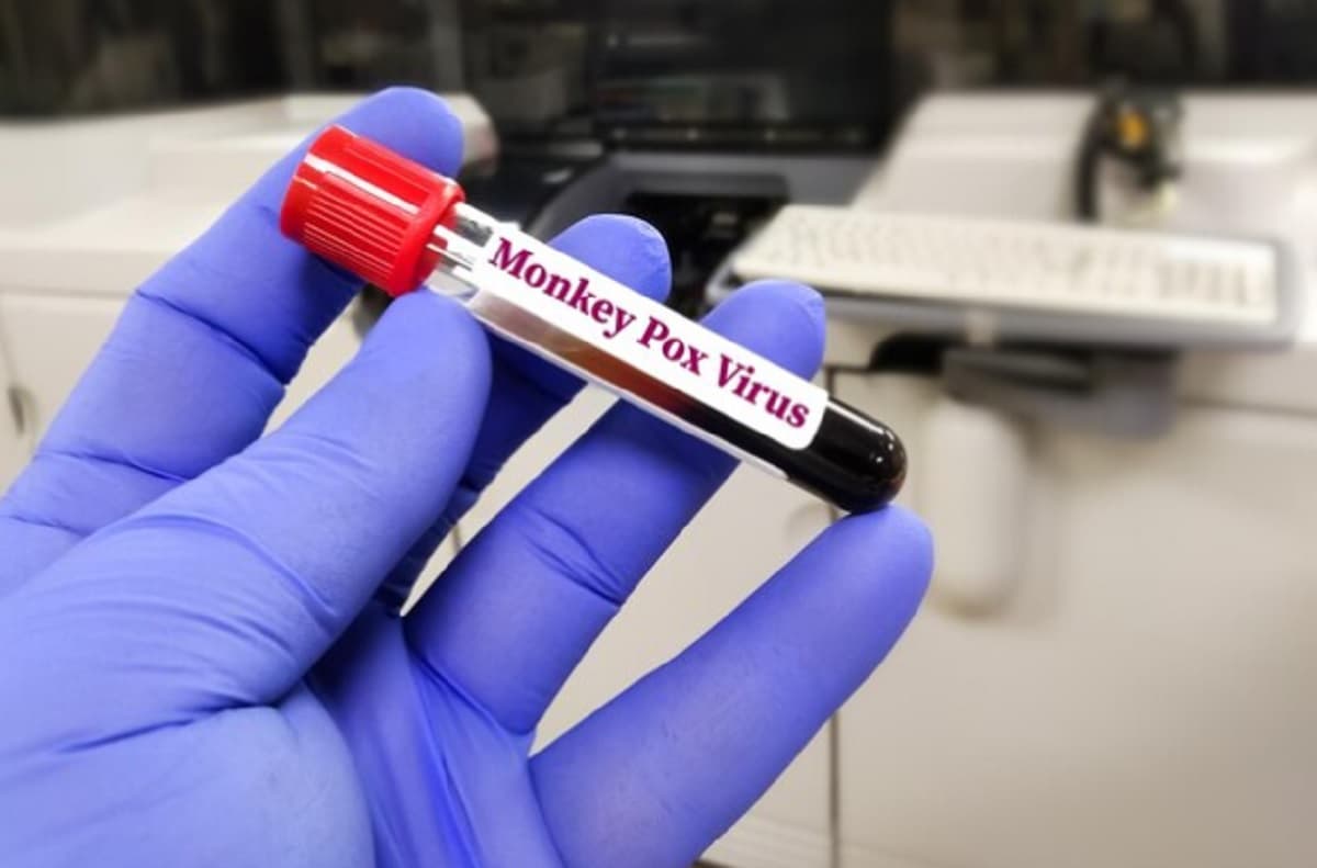 CDC Sebut Wabah Cacar Monyet di Kongo Lebih Mematikan CDC Sebut Wabah Cacar Monyet di Kongo Lebih Mematikan