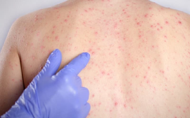 Cara Menyembuhkan Gabagen Pada Anak Anak dan Bayi Cara Menyembuhkan Gabagen Pada Anak Anak dan Bayi