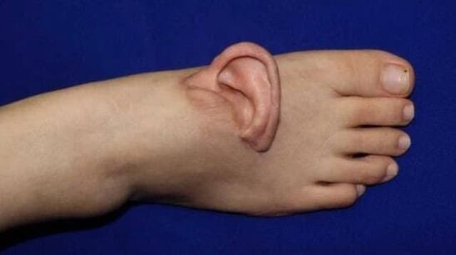 Telinga Wanita Ini di Ada Kaki Pascaoperasi Kecelakaan Kerja Telinga Wanita Ini di Ada Kaki Pascaoperasi Kecelakaan Kerja