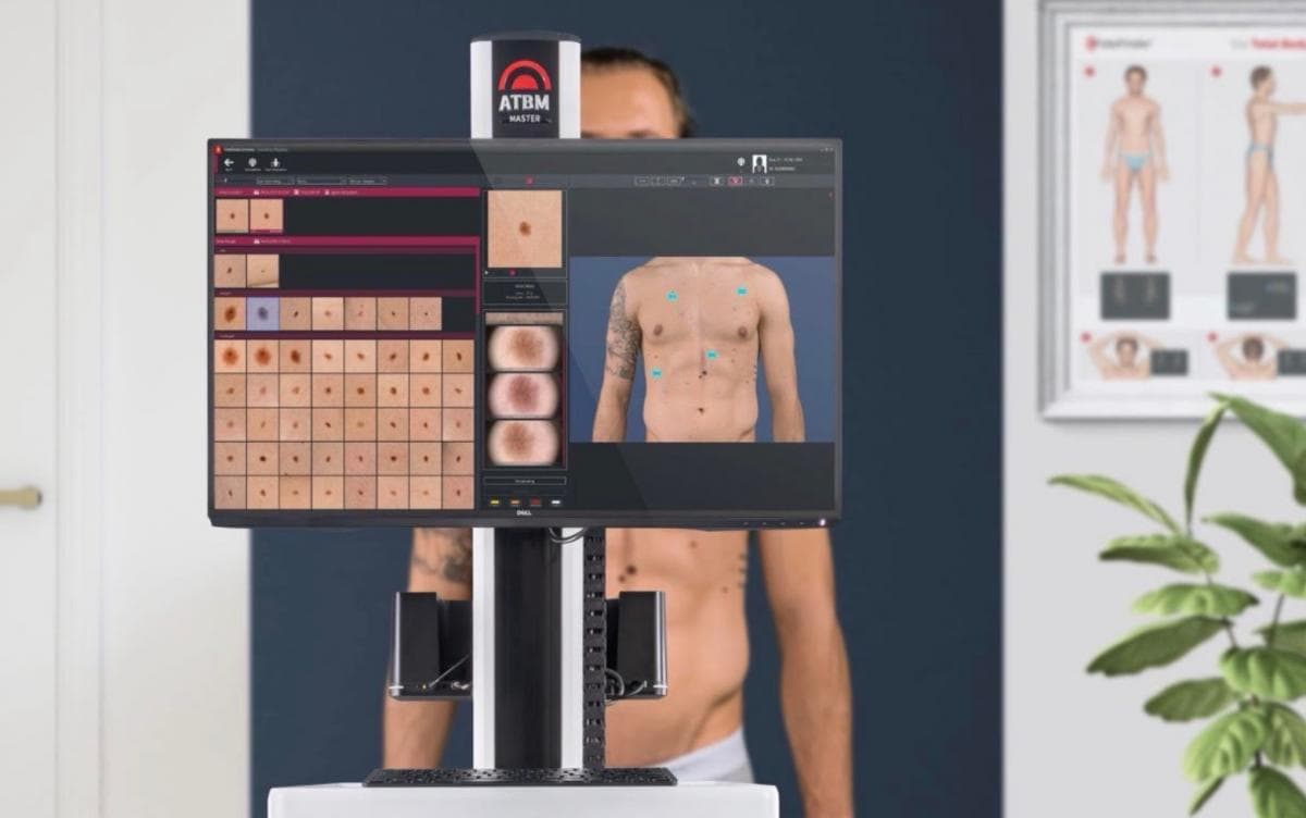 Deteksi Dini Kanker Kulit dengan TeknologiAI, Ini Kata Dokter! Deteksi Dini Kanker Kulit dengan TeknologiAI, Ini Kata Dokter!