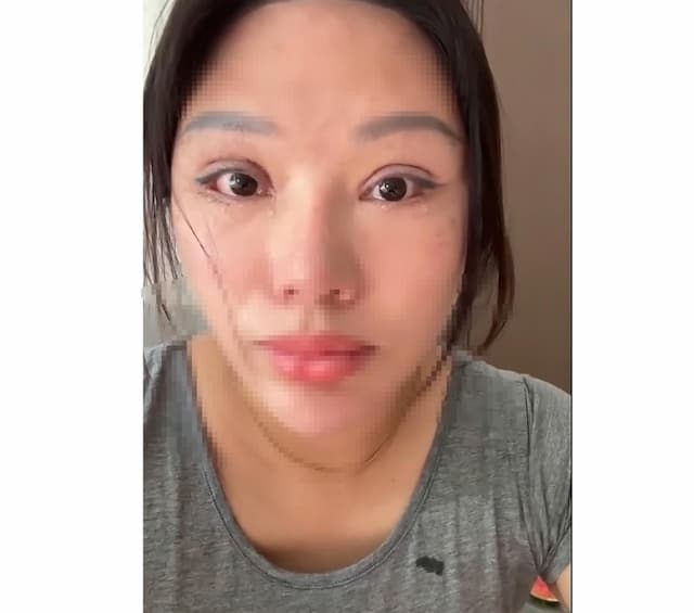 Viral! Perempuan Ini Tidak Bisa Tidur dengan Mata Tertutup Gegara Oplas Gagal Viral! Perempuan Ini Tidak Bisa Tidur dengan Mata Tertutup Gegara Oplas Gagal