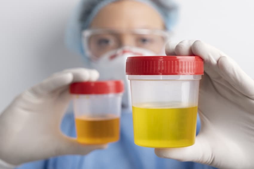 Terungkap, Alasan di Balik Urine Berwarna Kuning Terungkap, Alasan di Balik Urine Berwarna Kuning