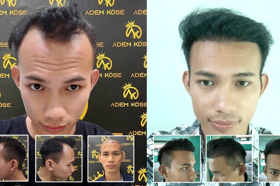 Ademkose Hair Transplant Hadir di Tanah Air, Bawa Standar Baru Transplantasi Rambut Ademkose Hair Transplant Hadir di Tanah Air, Bawa Standar Baru Transplantasi Rambut