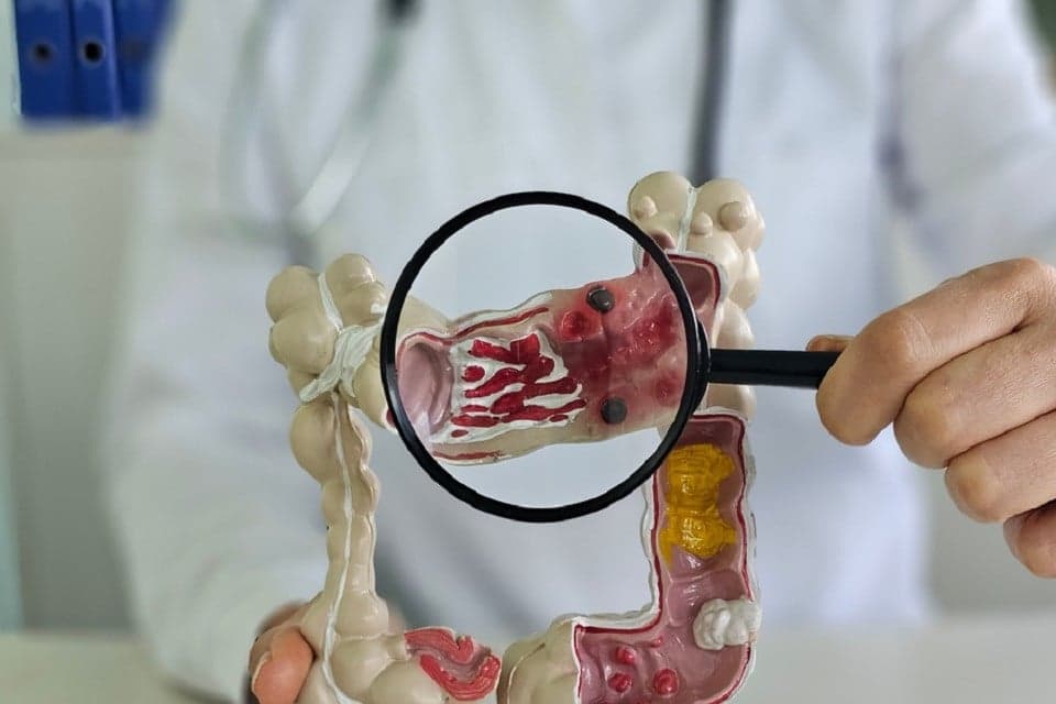 Kanker Usus Besar Mulai Serang Kalangan Anak Muda, Jangan Sepelekan Gejala Ini Kanker Usus Besar Mulai Serang Kalangan Anak Muda, Jangan Sepelekan Gejala Ini