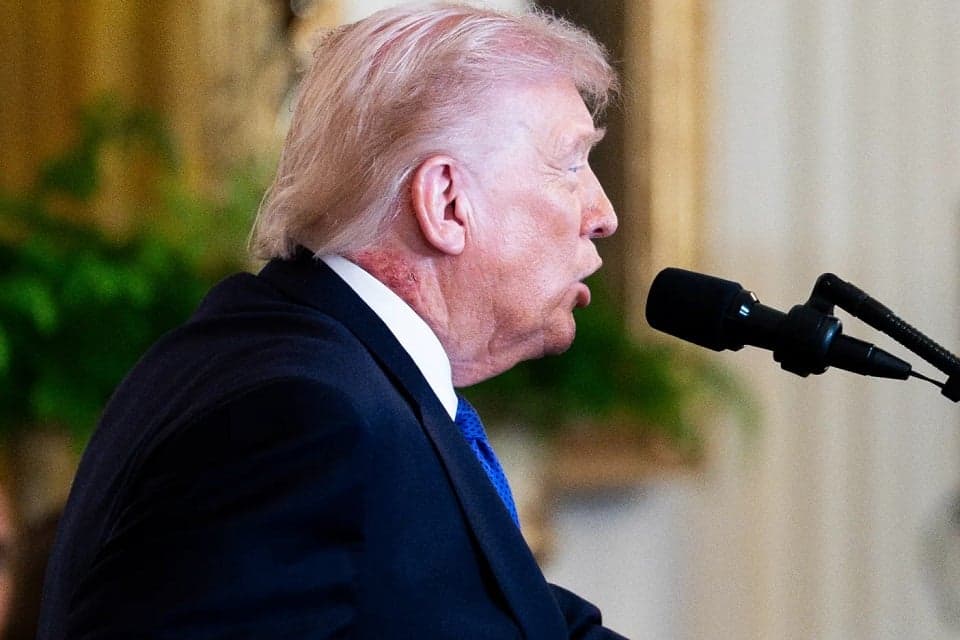 Ruam di Leher Trump Jadi Sorotan, Kondisi Kesehatannya Dipertanyakan Ruam di Leher Trump Jadi Sorotan, Kondisi Kesehatannya Dipertanyakan