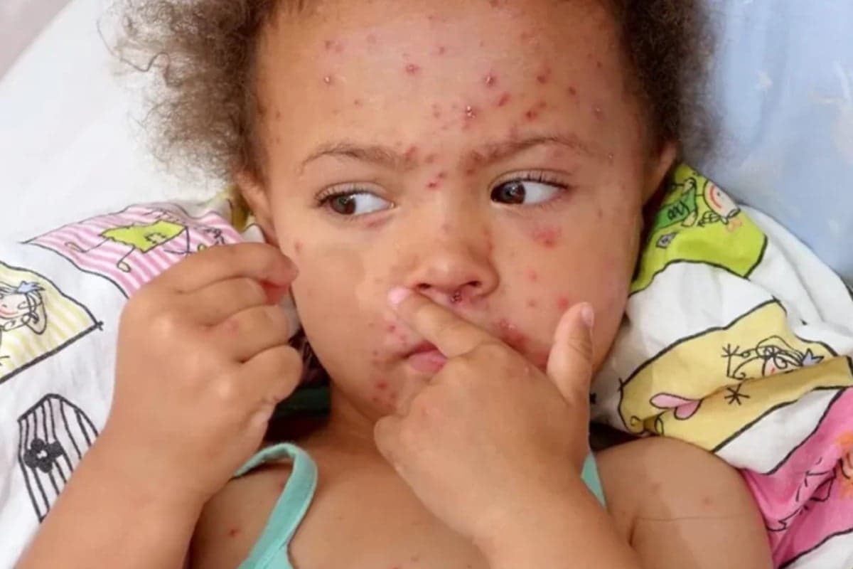 Dear Orang Tua, Ini 4 Cara Mencegah Penularan Campak pada Anak Dear Orang Tua, Ini 4 Cara Mencegah Penularan Campak pada Anak