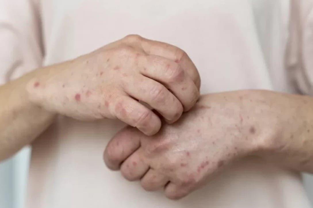 Izin Vaksin Campak untuk Dewasa Keluar, Kemenkes Prioritaskan Vaksinasi Nakes Izin Vaksin Campak untuk Dewasa Keluar, Kemenkes Prioritaskan Vaksinasi Nakes