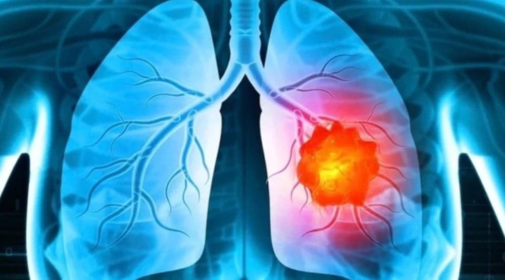 AI Jadi Mata yang Bisa Melihat dan Deteksi Kanker Paru-paru AI Jadi Mata yang Bisa Melihat dan Deteksi Kanker Paru-paru