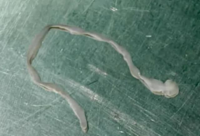 Cacing Sepanjang 8Cm Berenang di Otak Wanita Cacing Sepanjang 8Cm Berenang di Otak Wanita