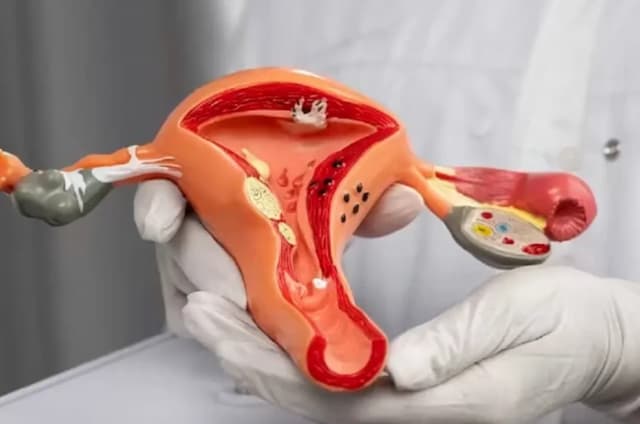 Skrining Kesehatan Perempuan Masih Rendah, Deteksi Dini HPV dan Kanker Serviks Jadi Kunci Skrining Kesehatan Perempuan Masih Rendah, Deteksi Dini HPV dan Kanker Serviks Jadi Kunci