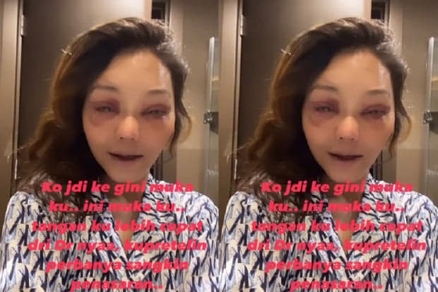 Bunda Corla Pamer Wajah Baru usai Operasi Plastik: Ini Mukaku? Bunda Corla Pamer Wajah Baru usai Operasi Plastik: Ini Mukaku?