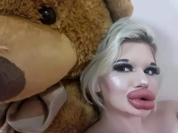 Pemilik Bibir Terbesar di Dunia Ingin Buat Rekor Baru Tulang Pipi Pemilik Bibir Terbesar di Dunia Ingin Buat Rekor Baru Tulang Pipi