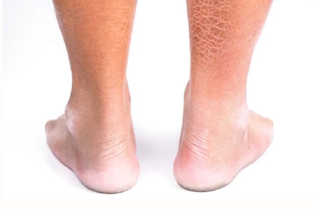 Mengenal Iktiosis, Kulit Bersisik Viral yang Dialami Wanita di Jawa Tengah Mengenal Iktiosis, Kulit Bersisik Viral yang Dialami Wanita di Jawa Tengah