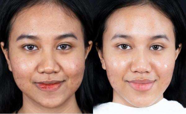 Ini Wajah Mayang Sebelum dan Sesudah Treatment Rp80 Juta, Auto Glowing Ini Wajah Mayang Sebelum dan Sesudah Treatment Rp80 Juta, Auto Glowing
