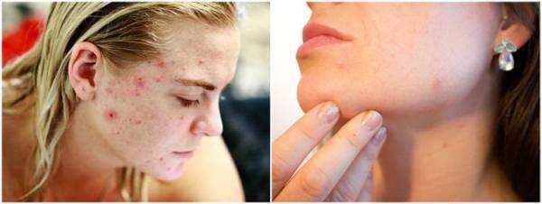 Rekomendasi 11 skincare untuk kulit berjerawat dan berminyak Rekomendasi 11 skincare untuk kulit berjerawat dan berminyak