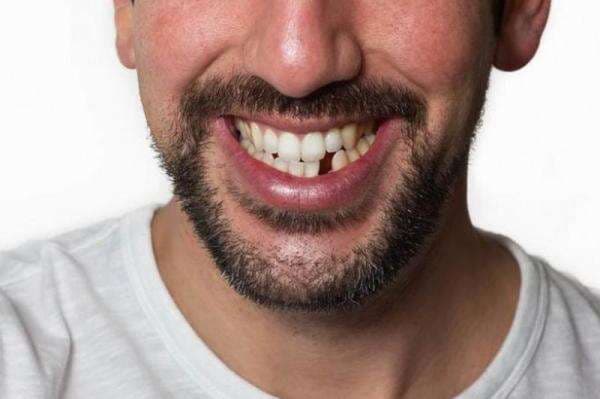 10 Arti Mimpi Gigi Bawah Copot dan Penjelasan Lengkap 10 Arti Mimpi Gigi Bawah Copot dan Penjelasan Lengkap